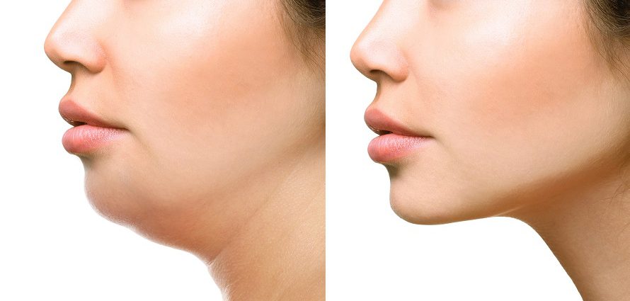 Neck Liposuction